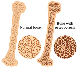 Osteoporosis | Obstetrics & Gynecology of Atlanta